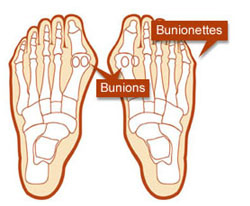 Bunions and bunionettes diagram