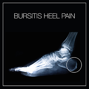 Bursitis Heel Pain