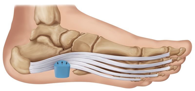 Plantar Fasciitis Bar Medical Illustration