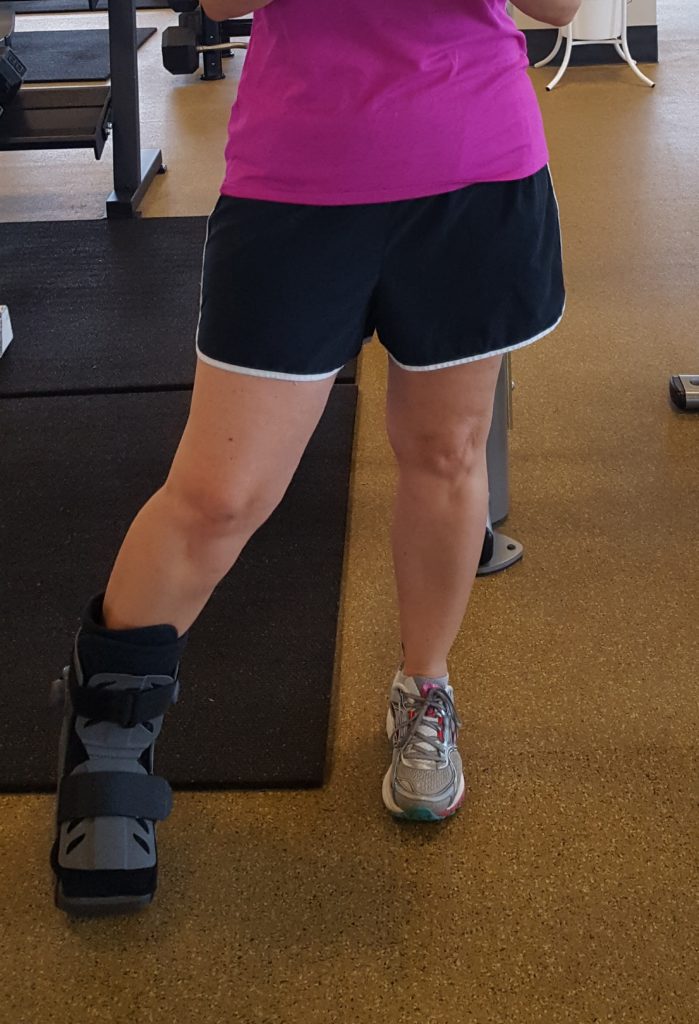 Plantar Fasciitis Surgery Recovery Photo