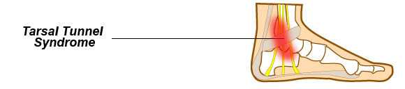 Tarsal Tunnel Syndrome