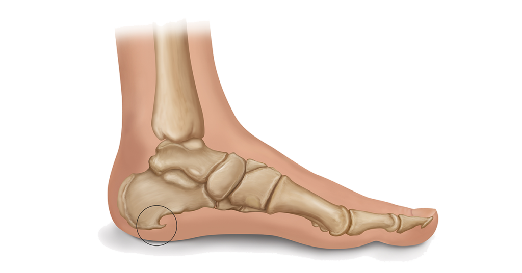 Heel Spur Illustration