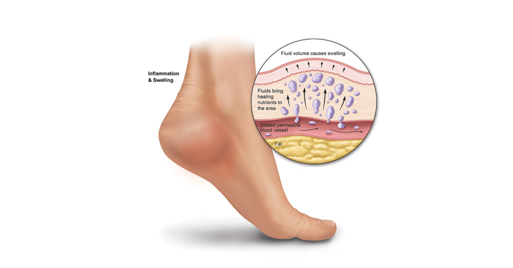Swelling and inflammation caused by plantar fasciitis